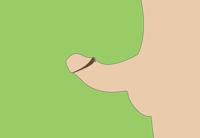 peenise kõverus kui näidustus kirurgiliseks suurendamiseks